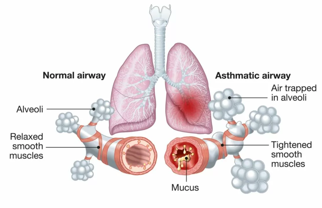 Sambandet mellan idiopatisk lungfibros och astma